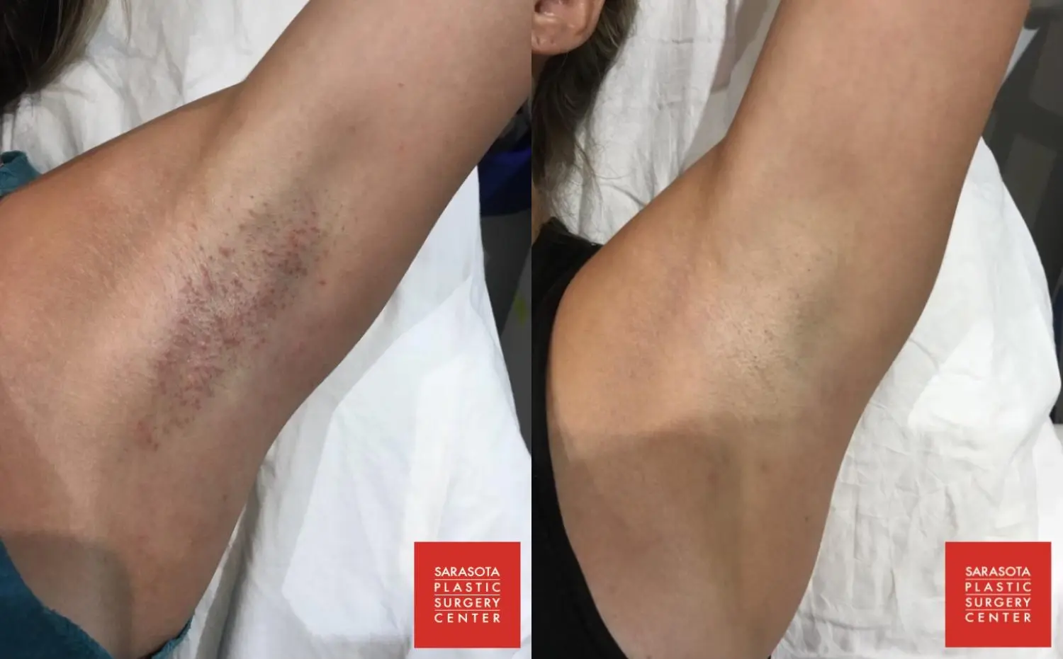 Laser Hair Removal: Patient 1 - Before and After  