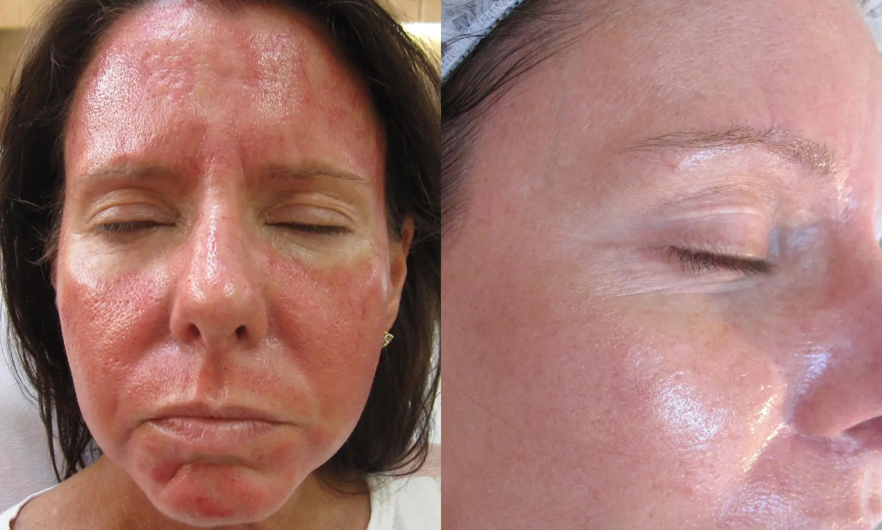 Microneedling: Patient 1 - Before and After  