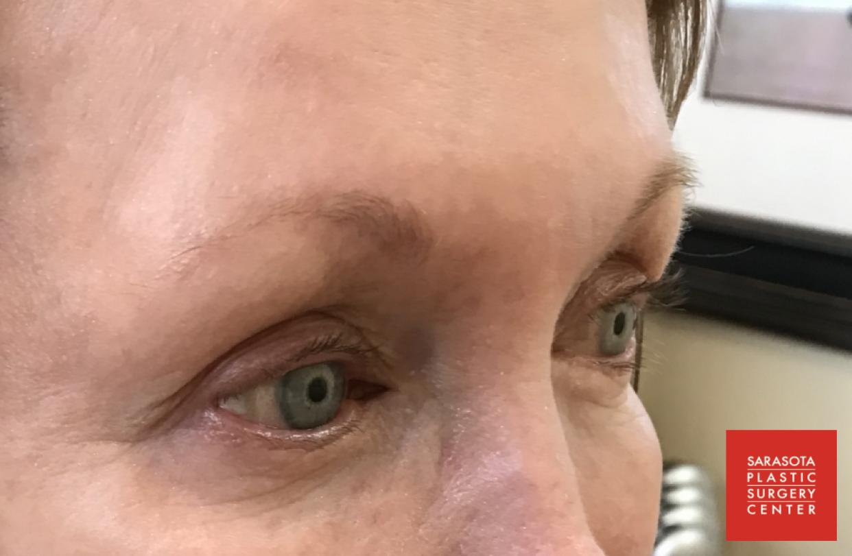 Permanent Makeup - Eyebrows: Patient 22 - Before 
