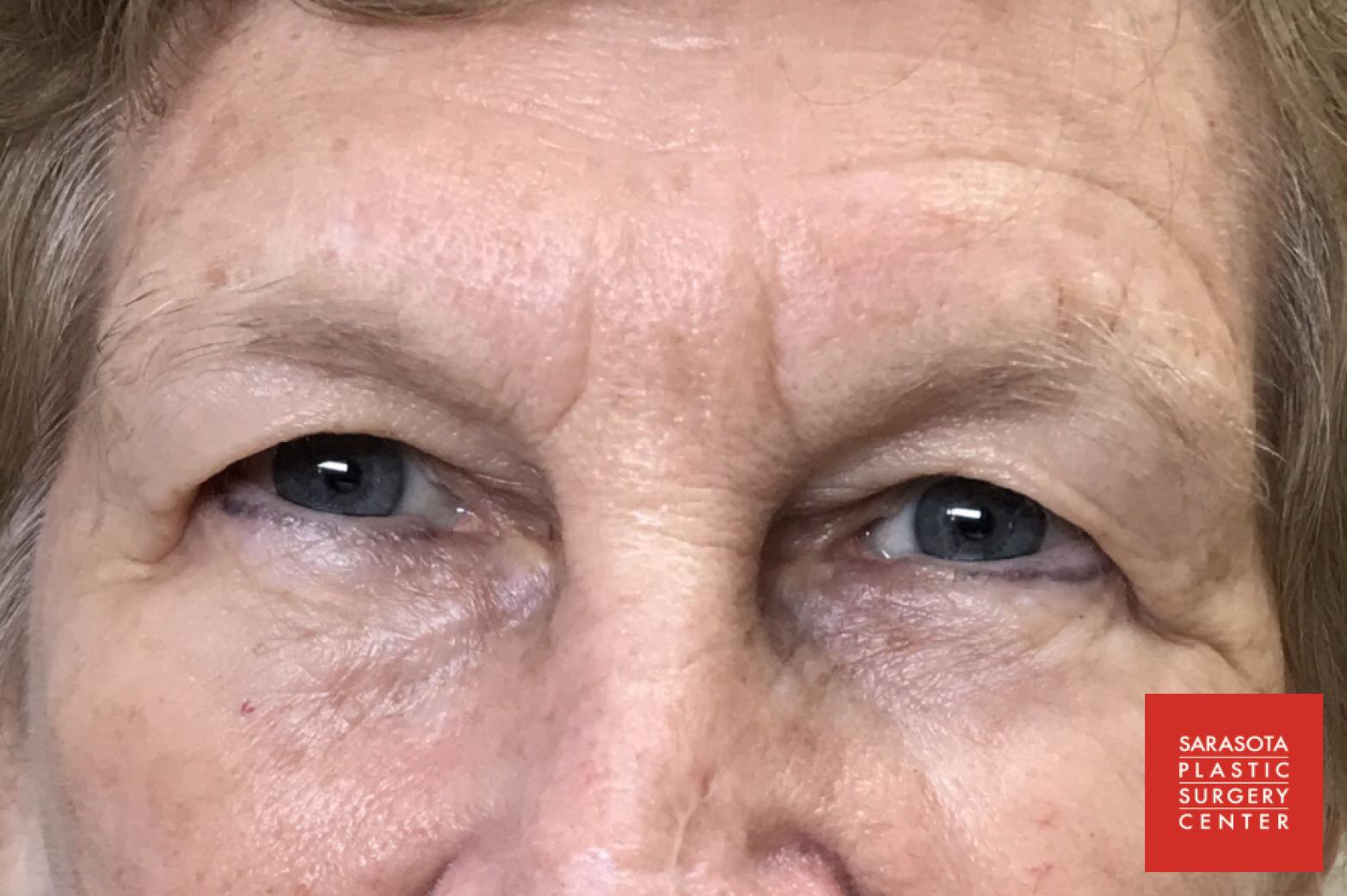 Permanent Makeup - Eyebrows: Patient 20 - Before 