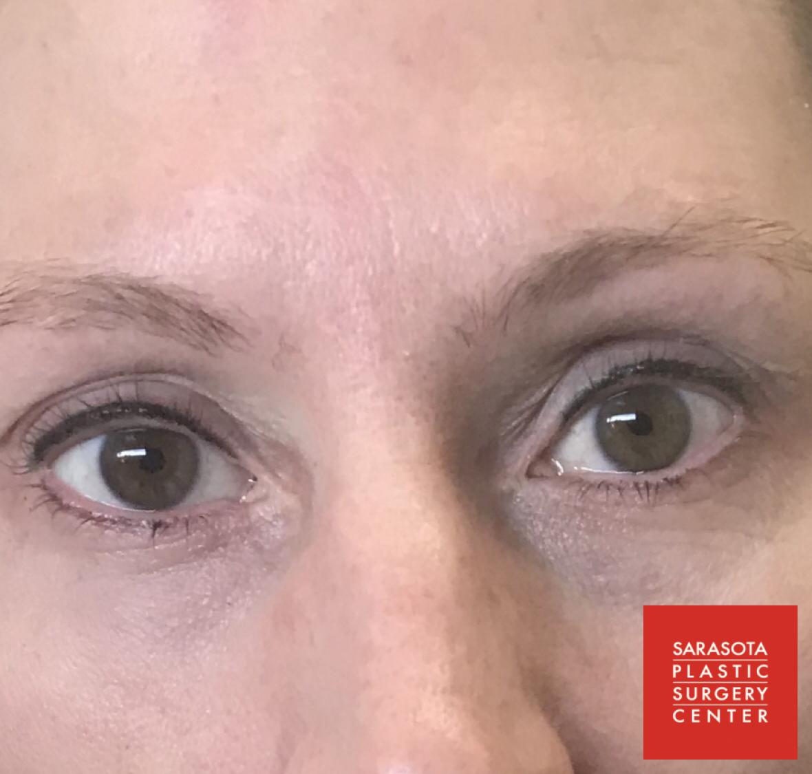 Permanent Makeup - Eyeliner: Patient 8 - After  