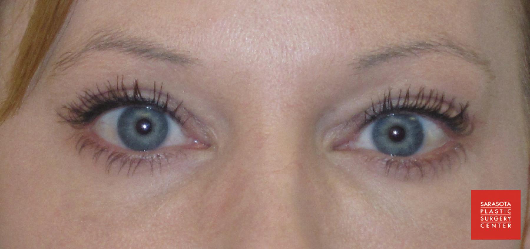 Permanent Makeup - Eyeliner: Patient 1 - After  