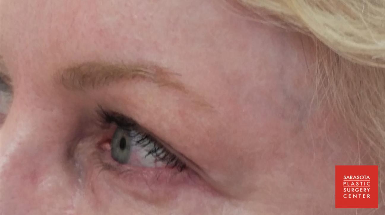 Permanent Makeup - Eyebrows: Patient 14 - Before 
