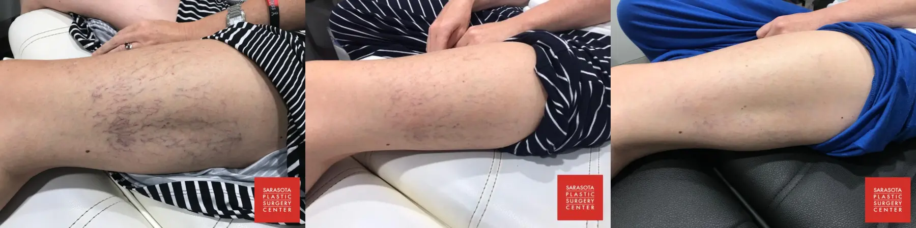 Sclerotherapy: Patient 1 - Before and After  