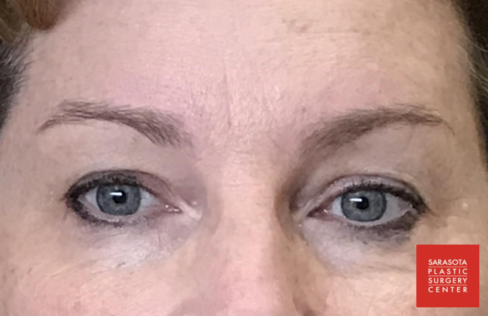 Permanent Makeup - Eyebrows: Patient 18 - Before 