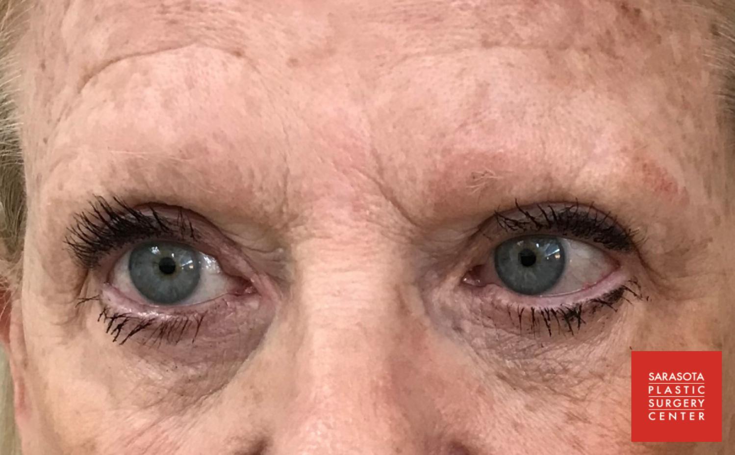 Permanent Makeup - Eyebrows: Patient 17 - Before 