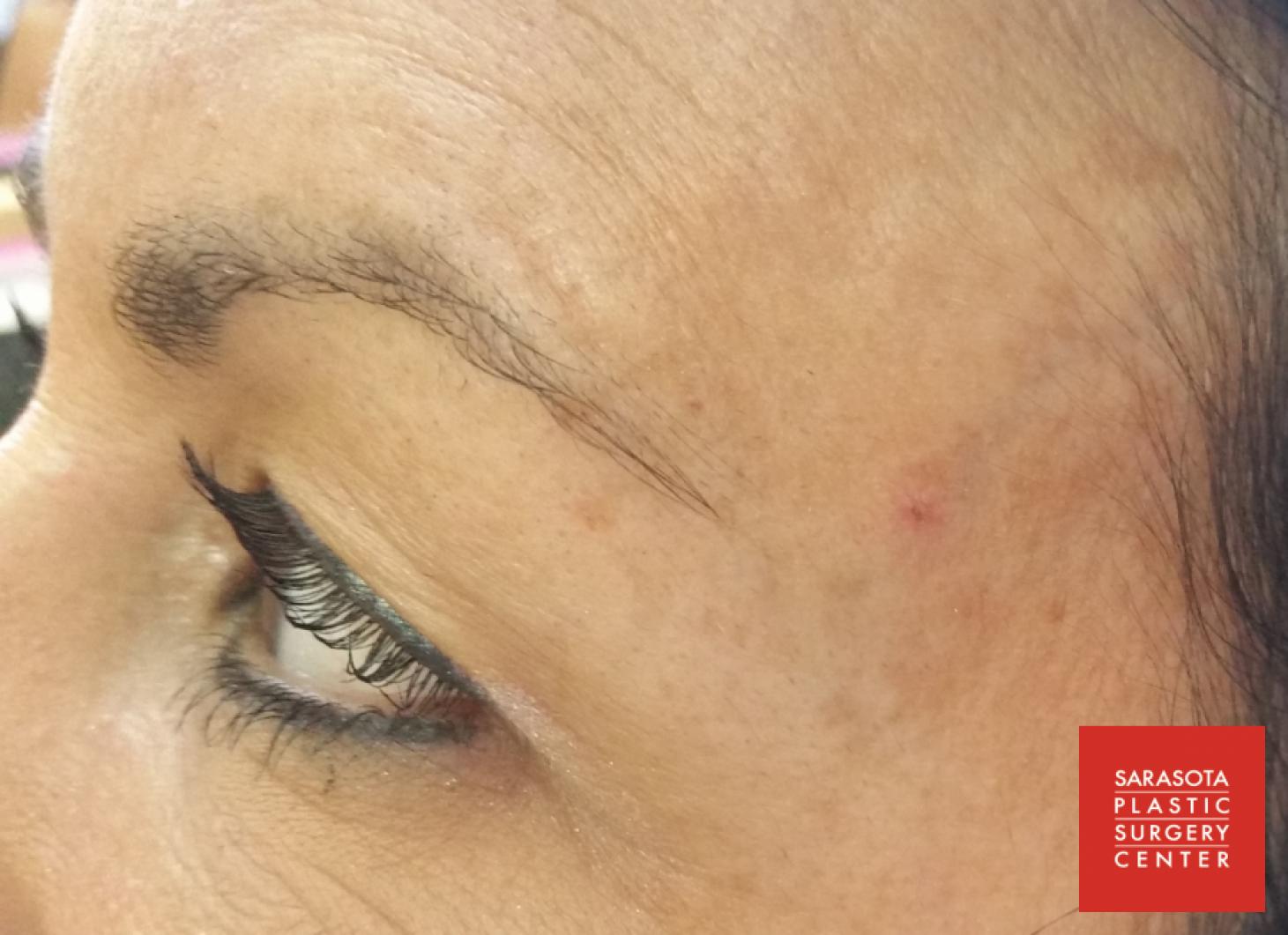 Permanent Makeup - Eyebrows: Patient 4 - After  