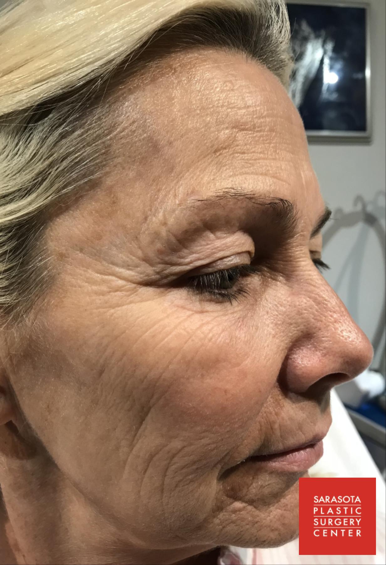 Intense Pulsed Light (IPL): Patient 5 - After 2