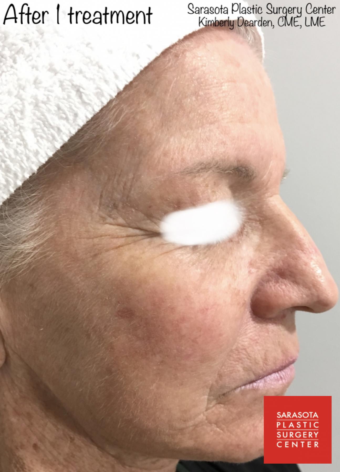 Intense Pulsed Light (IPL): Patient 1 - After  