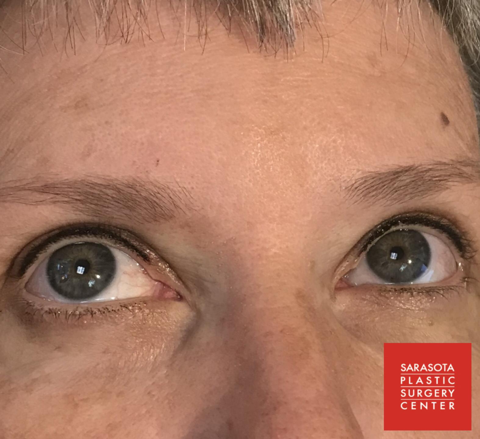 Permanent Makeup - Eyeliner: Patient 7 - After  