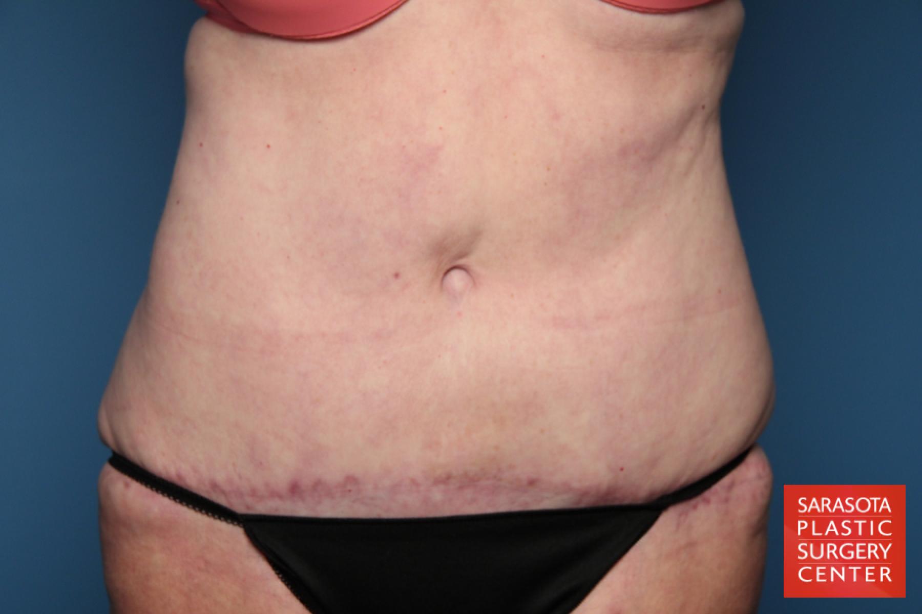 Tummy Tuck: Patient 15 - After 1