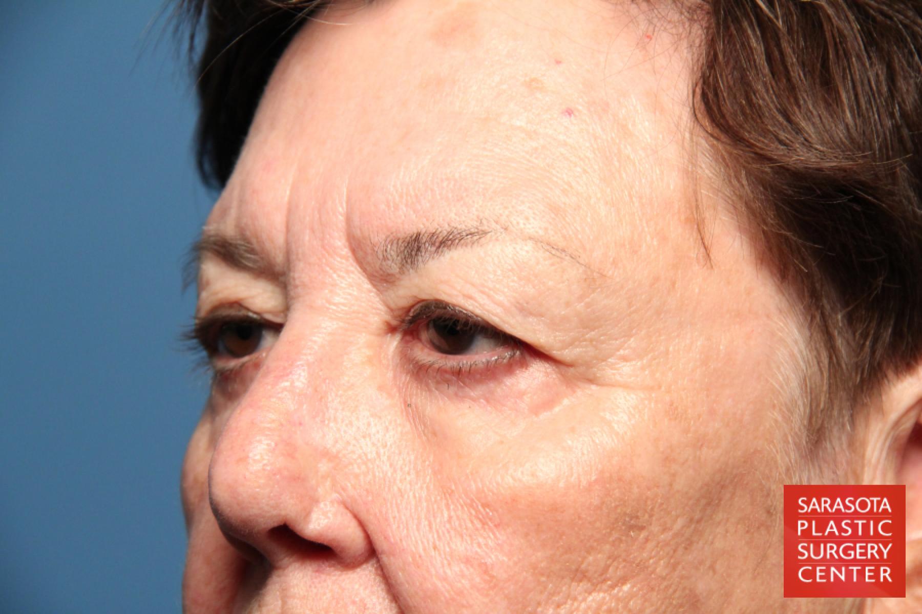 Eyelid Lift: Patient 17 - Before 3