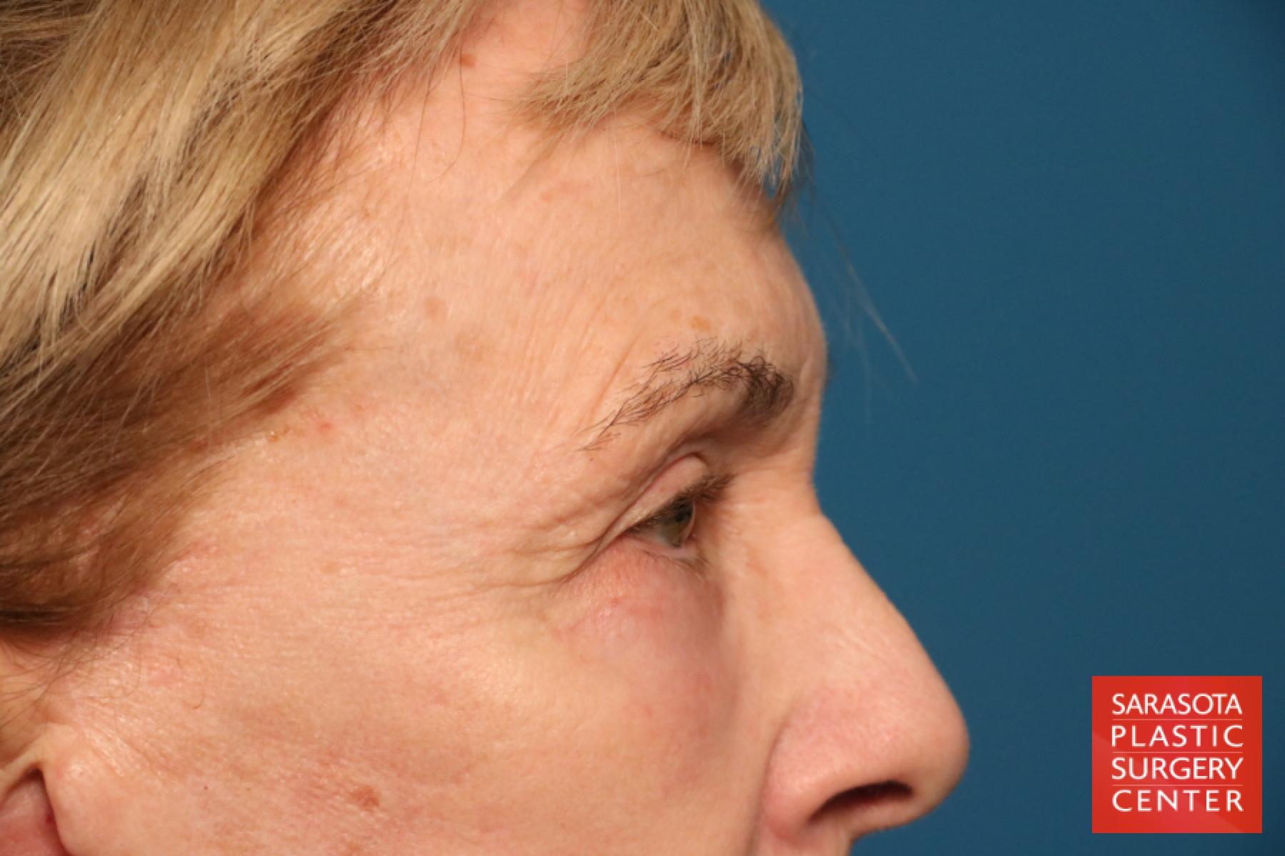 Eyelid Lift: Patient 43 - After 4