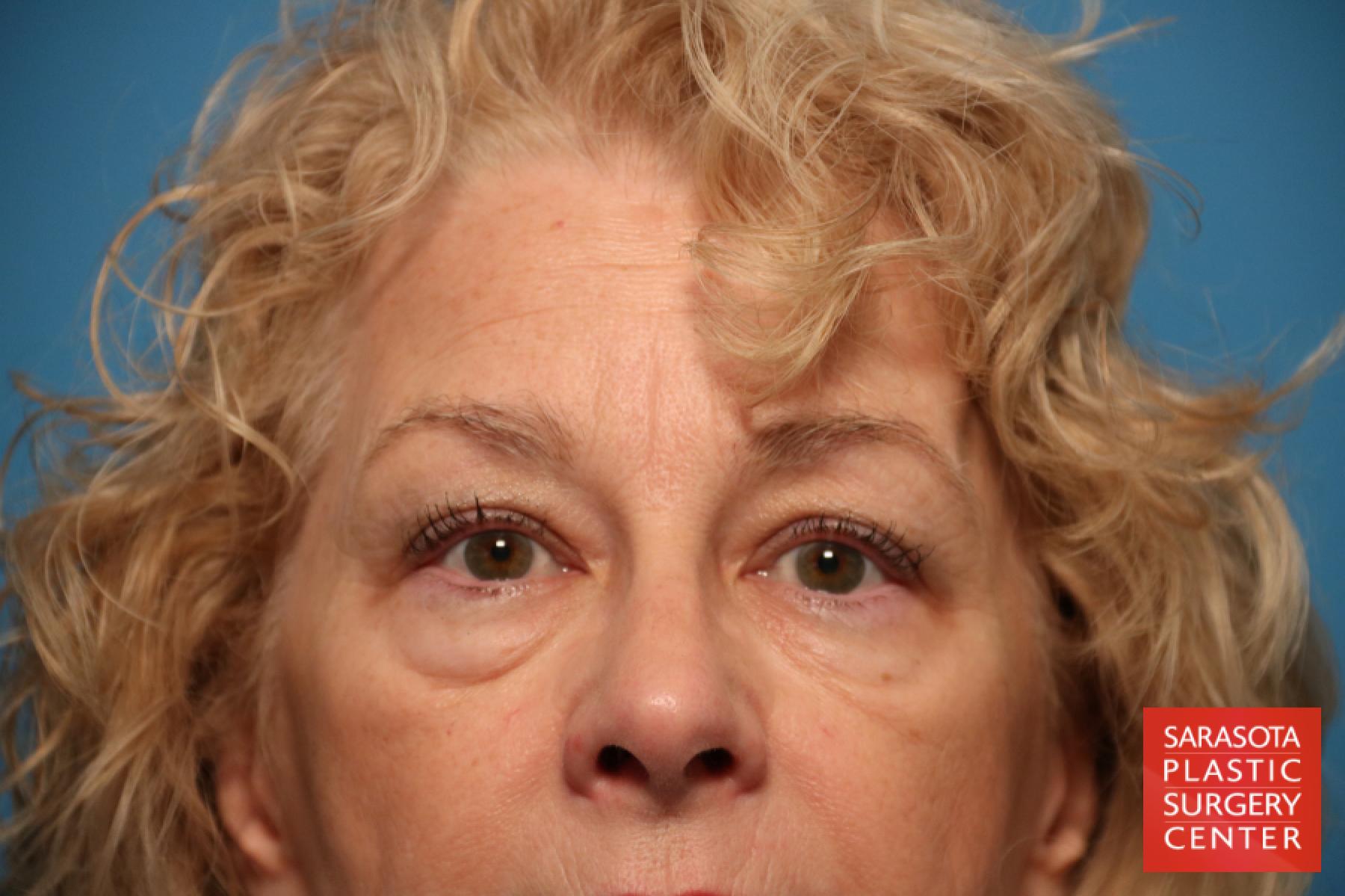 Eyelid Lift: Patient 19 - Before 1