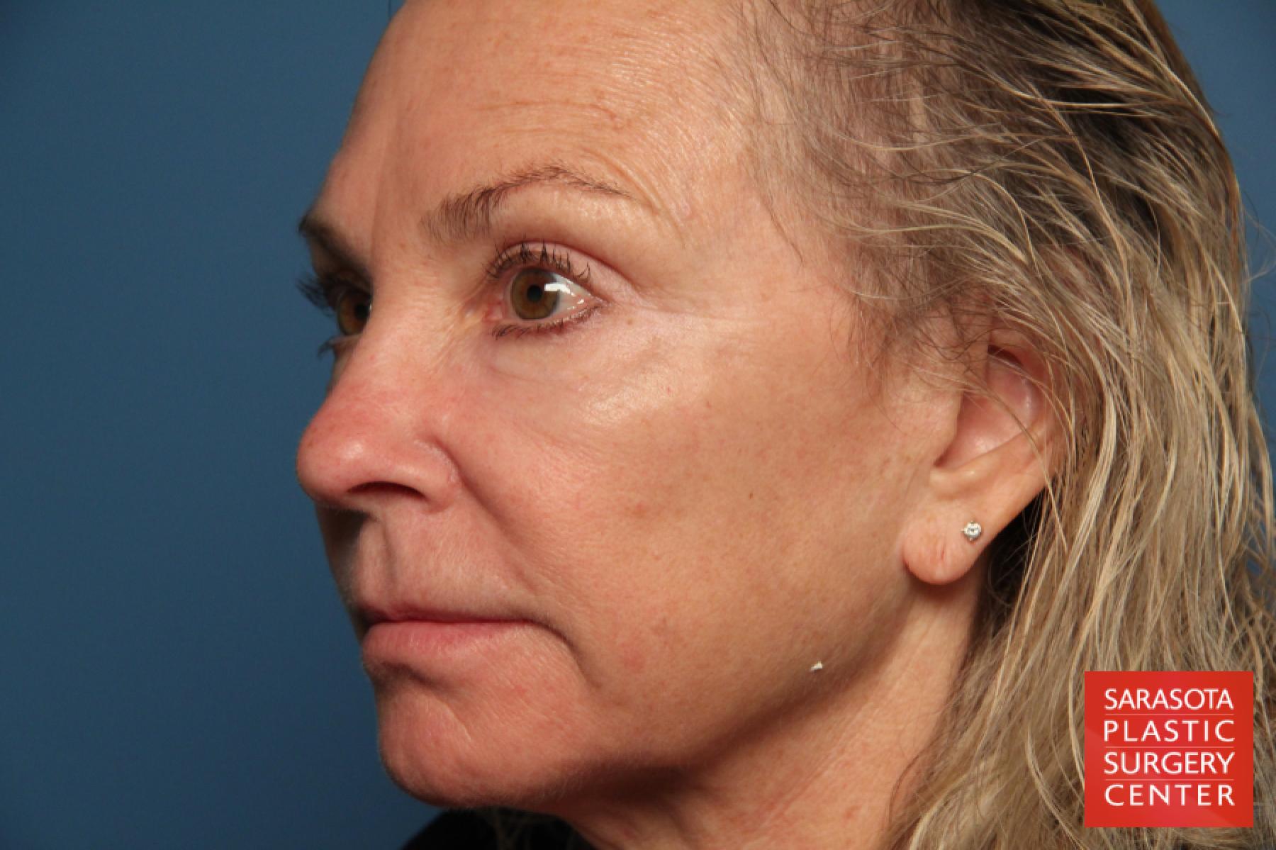 Laser Skin Resurfacing - Face: Patient 9 - After 2
