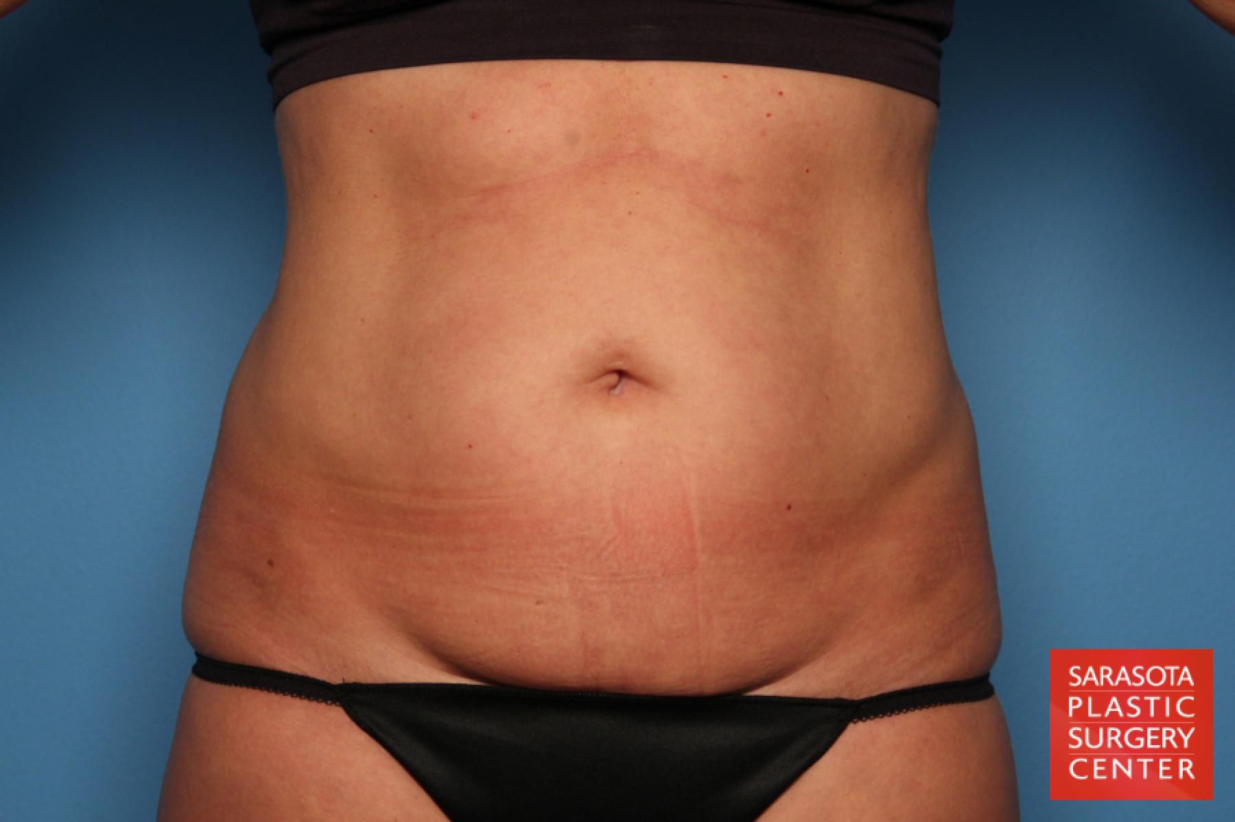 Tummy Tuck: Patient 25 - Before 1