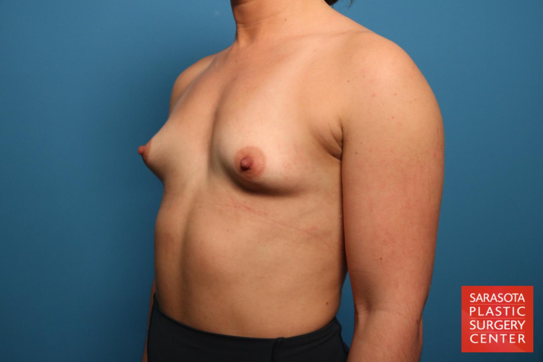 Breast Augmentation: Patient 64 - Before 2