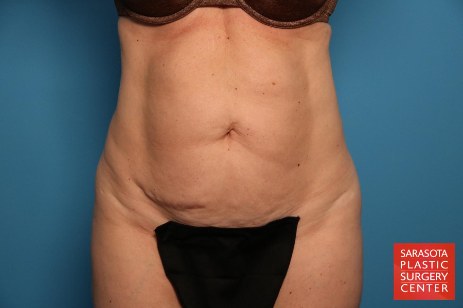 Tummy Tuck: Patient 23 - Before 1