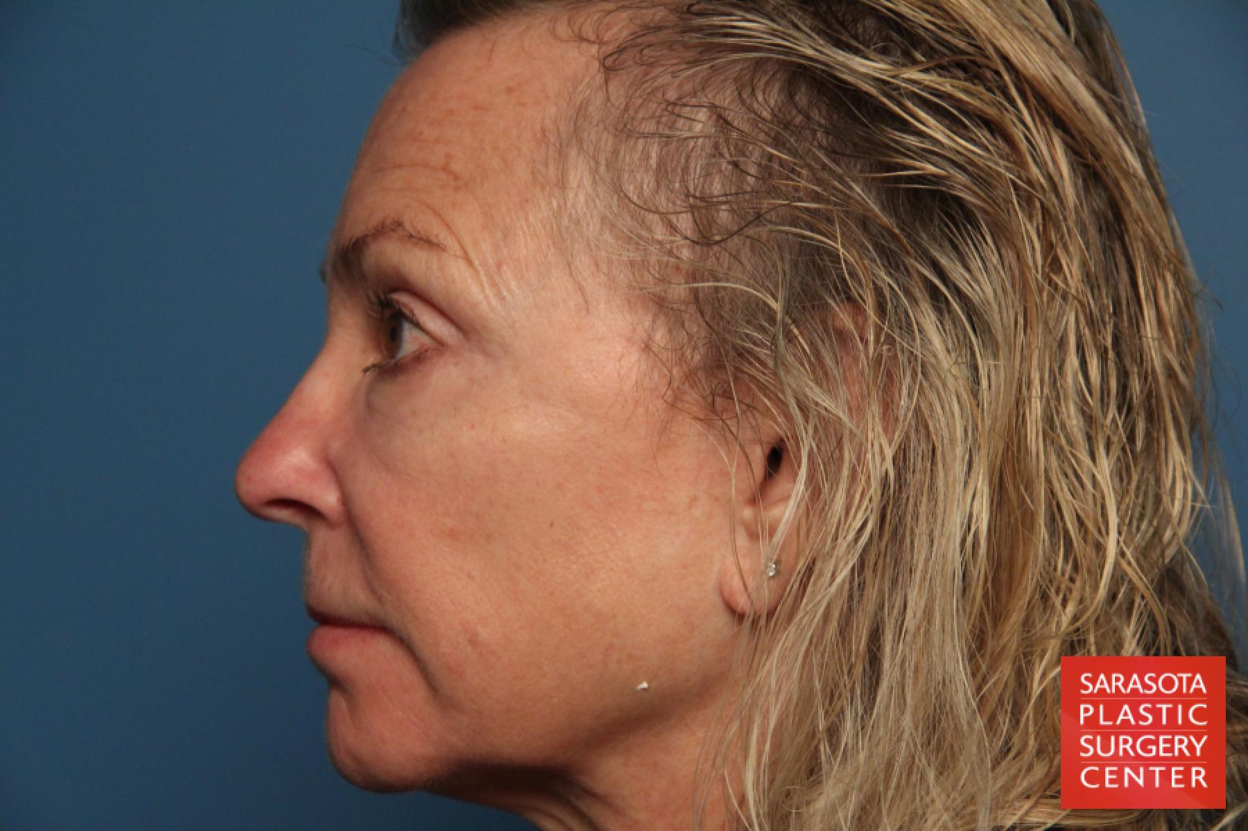 Laser Skin Resurfacing - Face: Patient 9 - After 3
