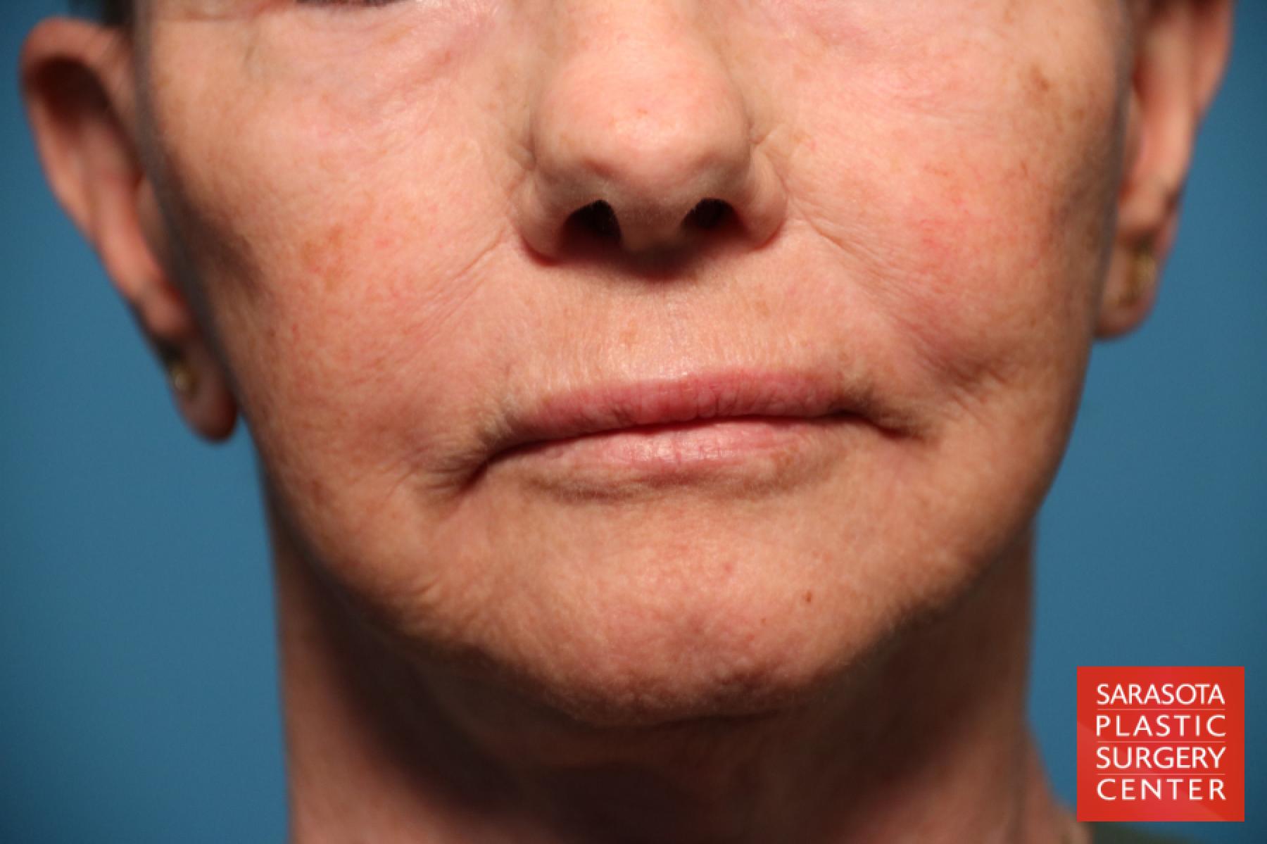 Laser Skin Resurfacing - Face: Patient 14 - After 1