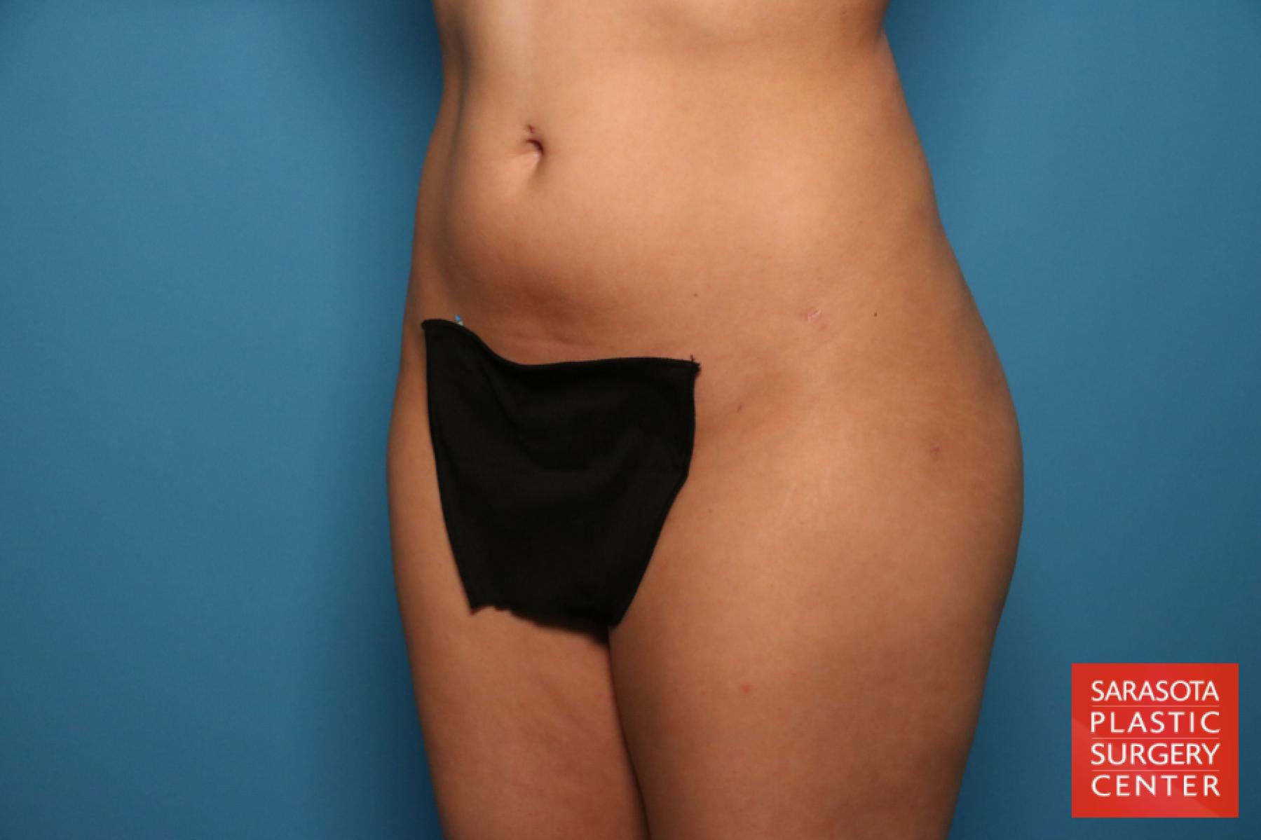 Liposuction: Patient 15 - After 2