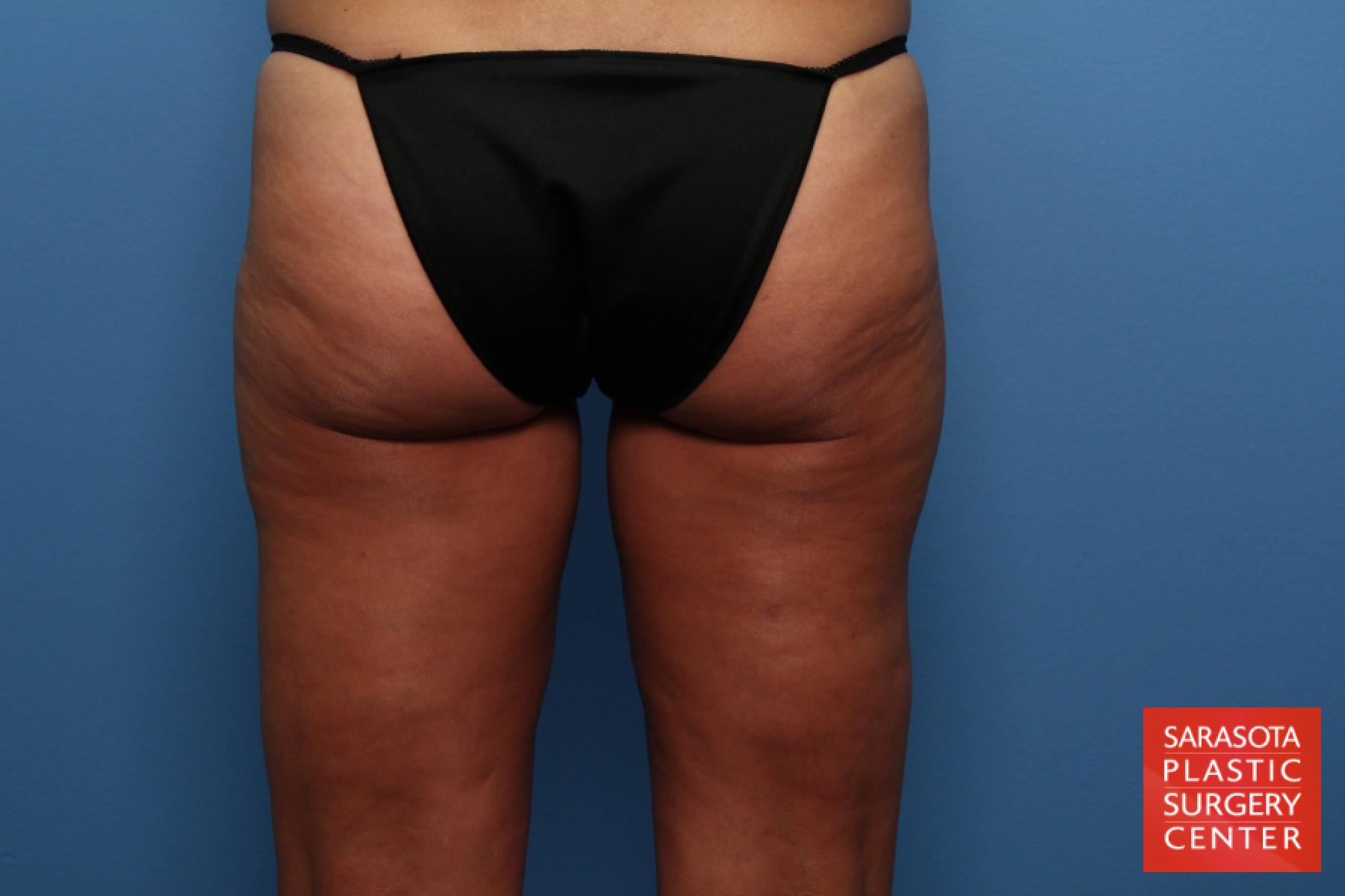 Liposuction: Patient 3 - After 5