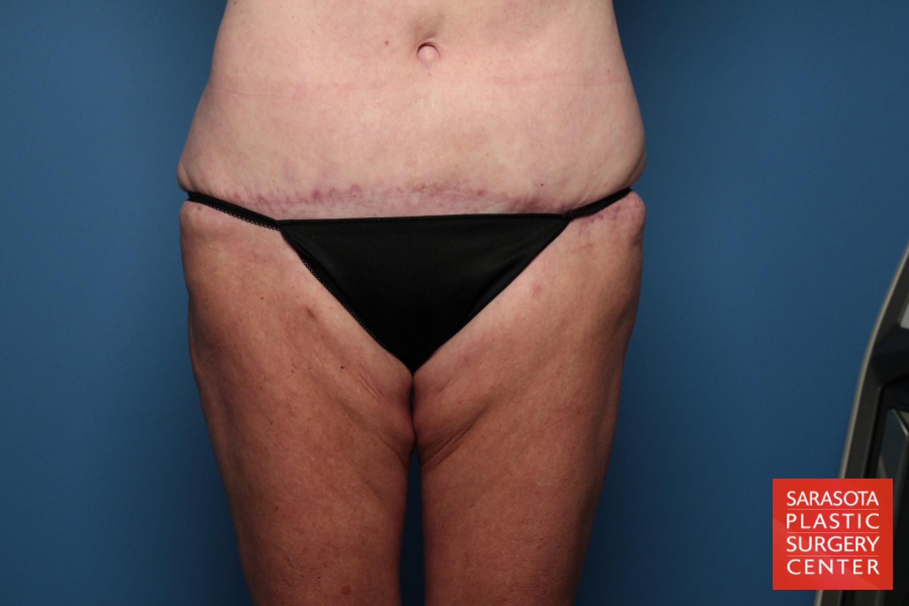 Tummy Tuck: Patient 15 - After 4