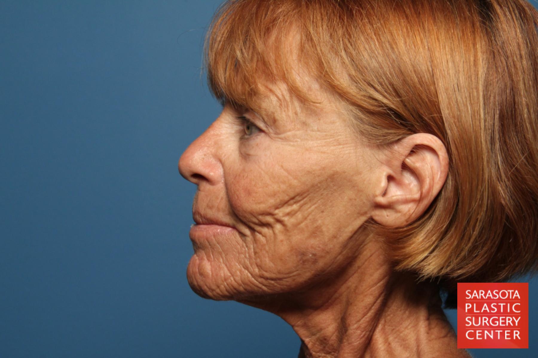 Cheek Lift: Patient 10 - Before and After 3