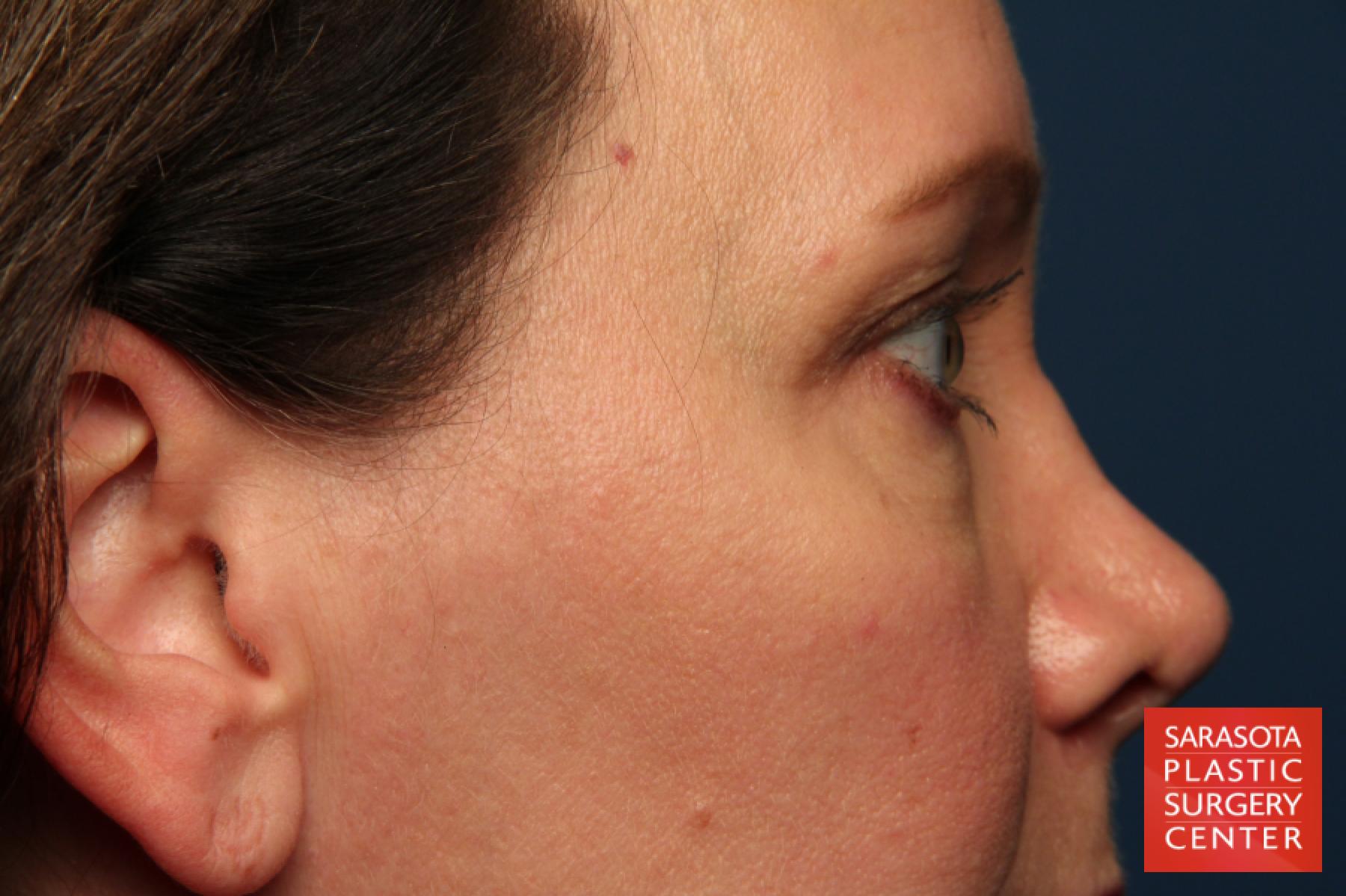 Eyelid Lift: Patient 40 - Before and After 5