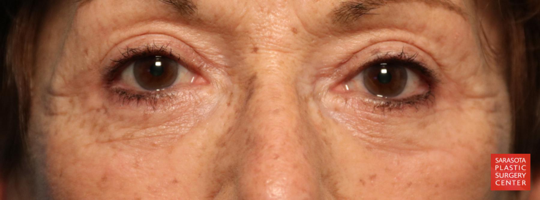 Eyelid Lift: Patient 6 - After  