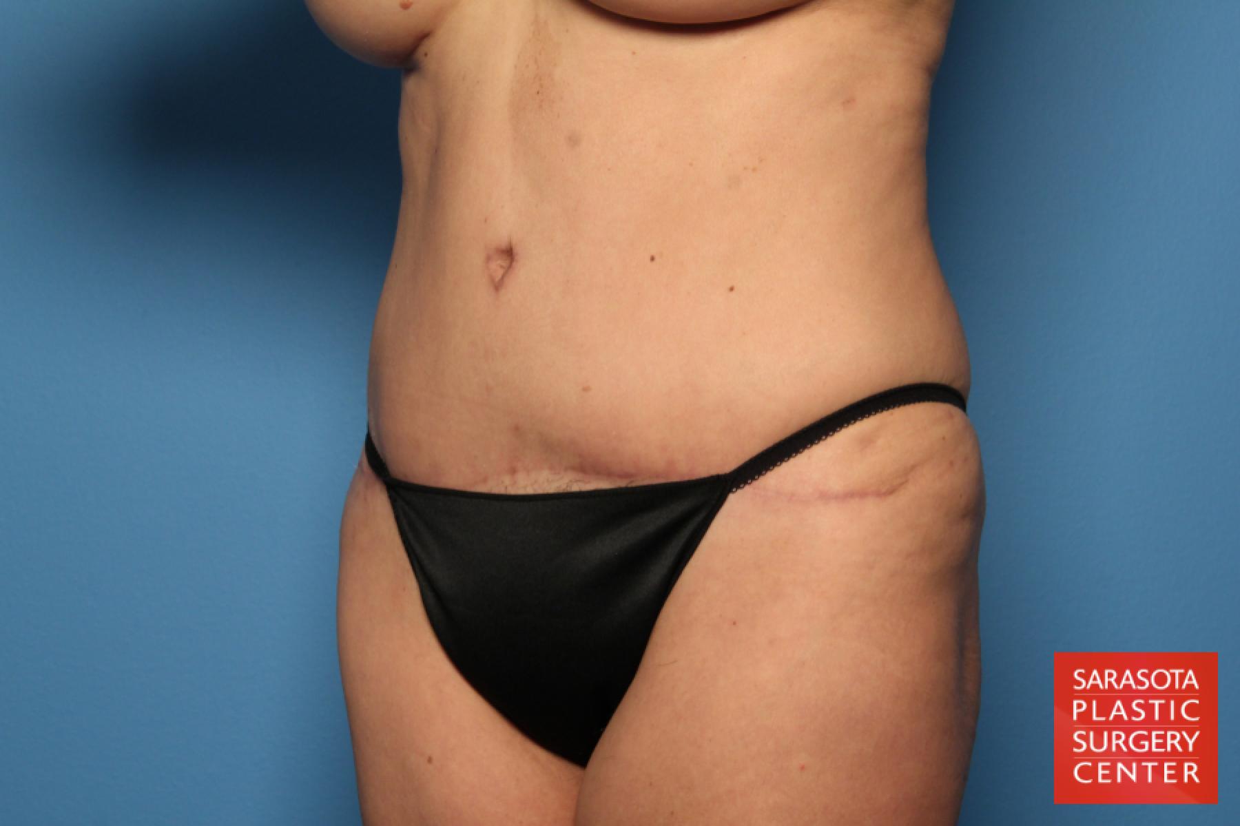 Tummy Tuck: Patient 4 - After 2