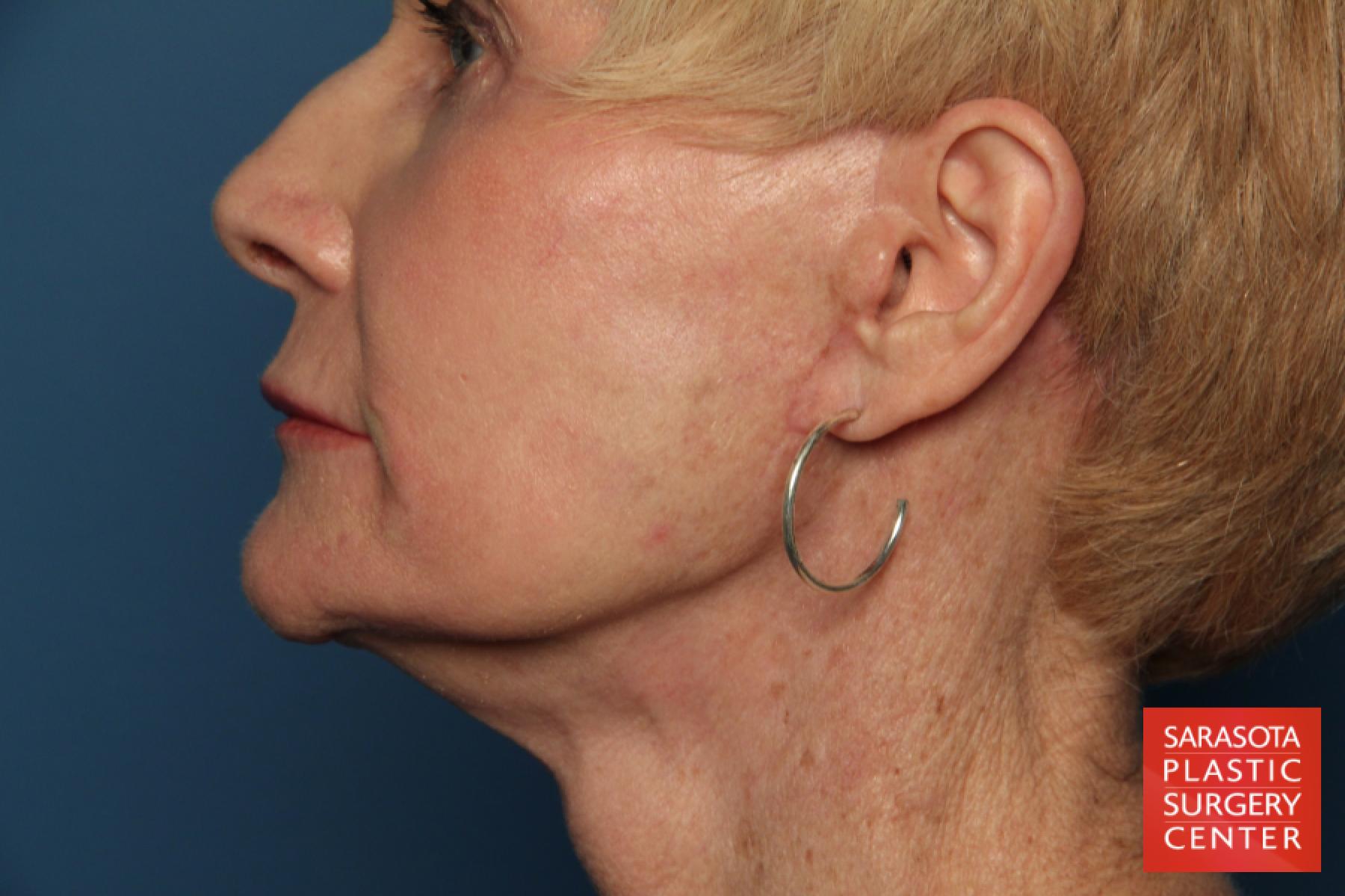 Laser Skin Resurfacing - Face: Patient 15 - After 3