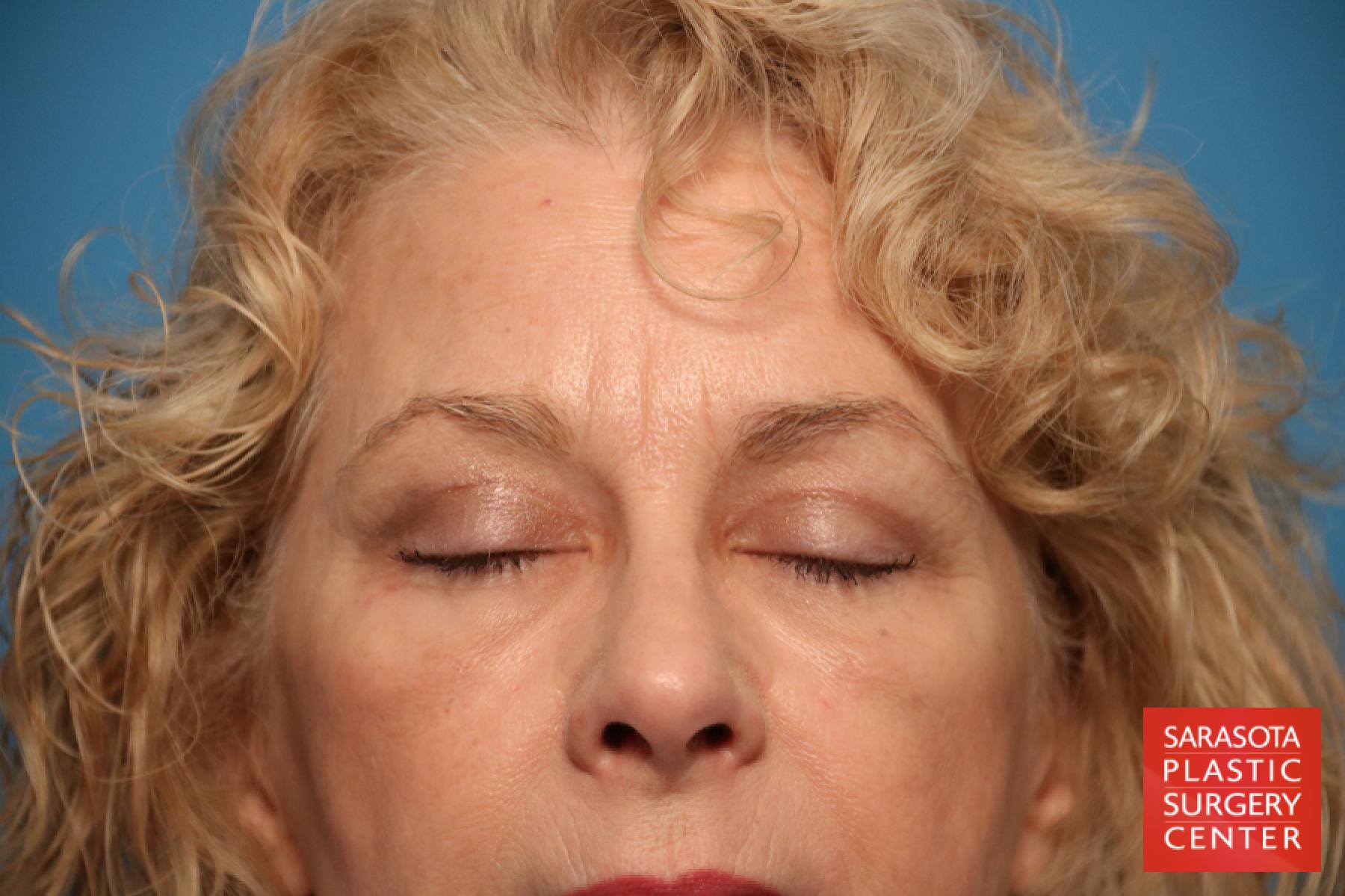 Eyelid Lift: Patient 19 - After 2