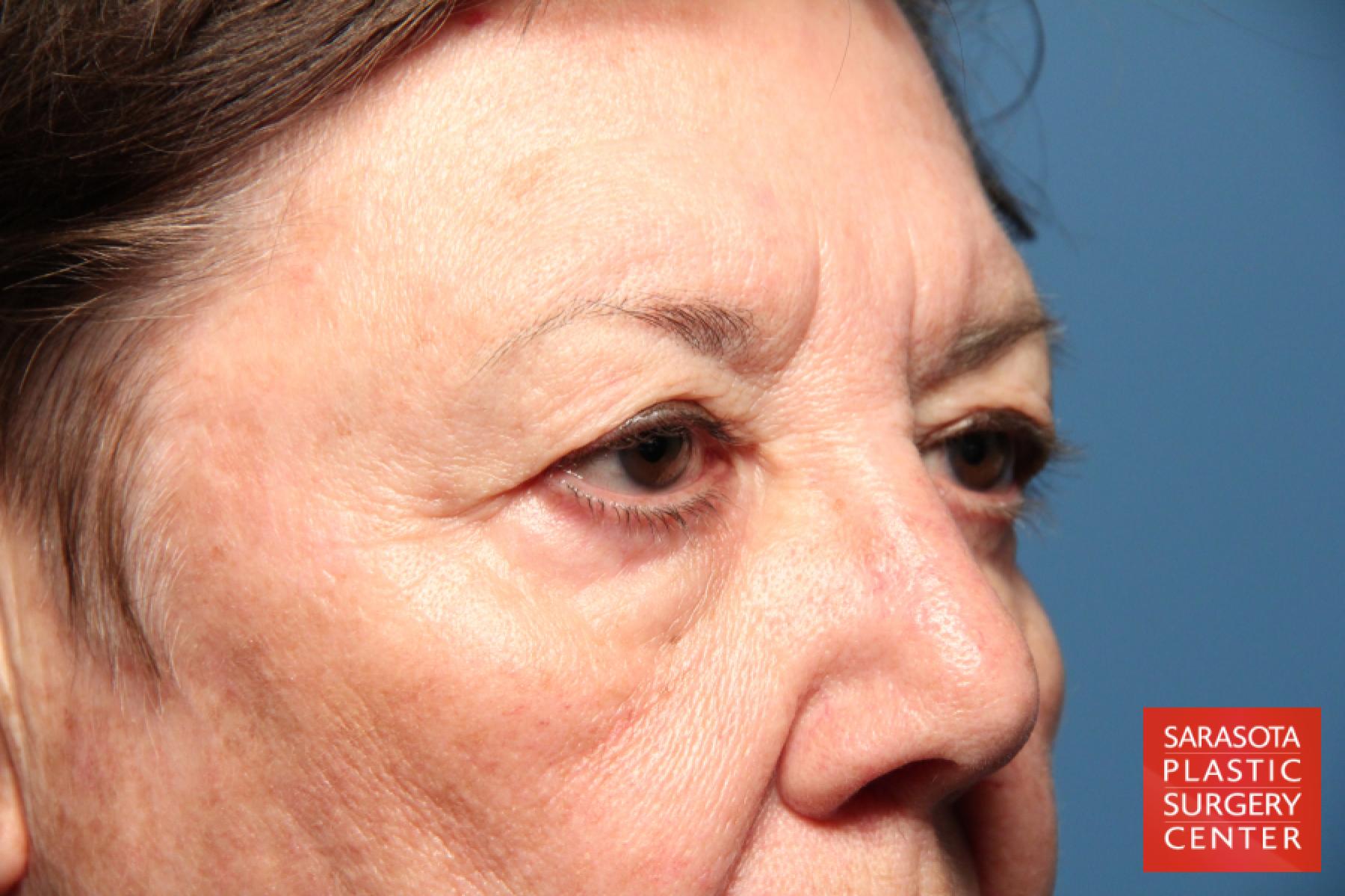 Facelift: Patient 23 - Before and After 3