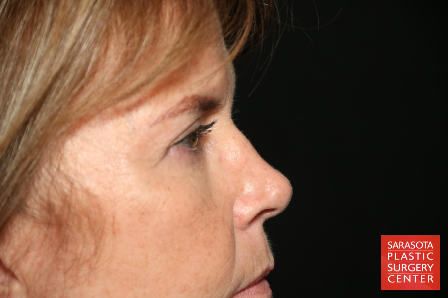 Eyelid Lift: Patient 37 - After 4