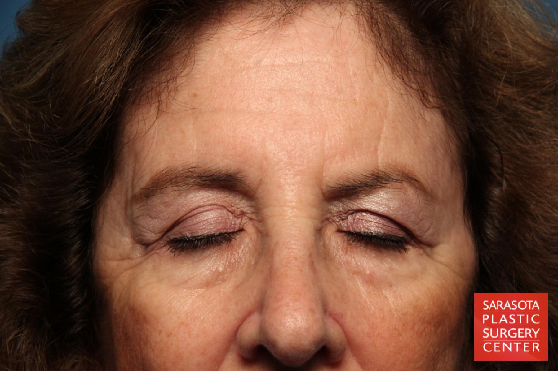 Eyelid Lift: Patient 42 - Before 2