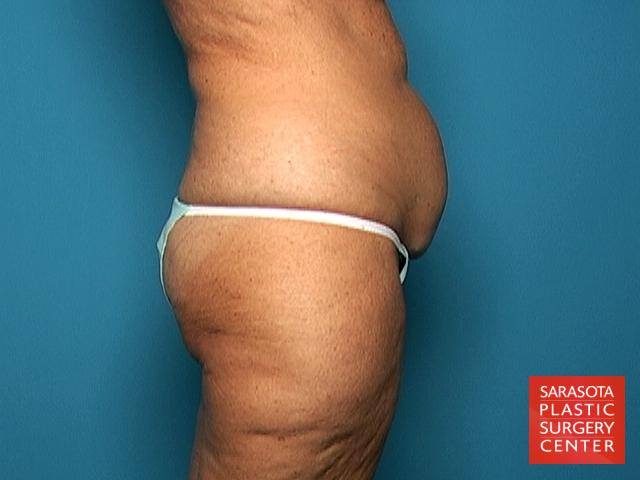 Liposuction: Patient 9 - Before and After 7