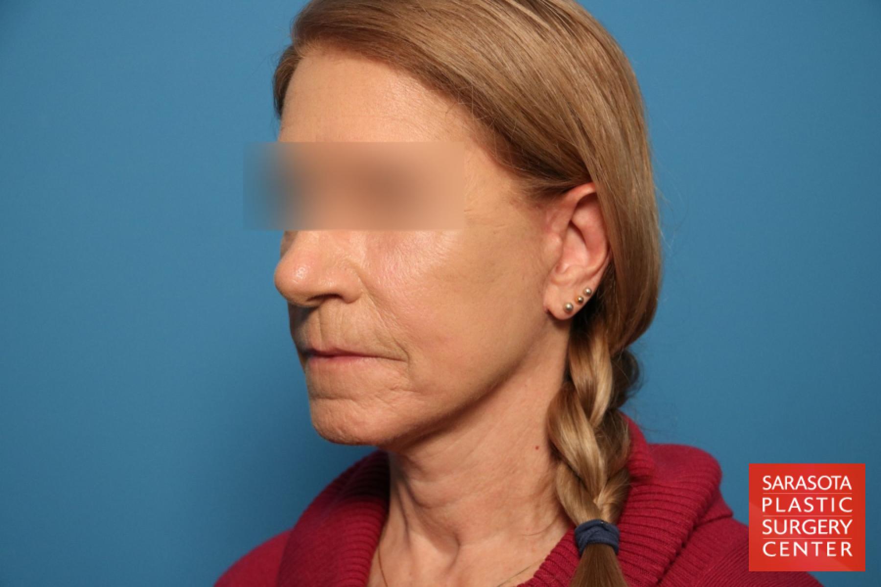 Laser Skin Resurfacing - Face: Patient 13 - After 2
