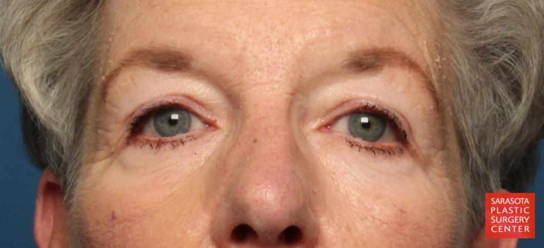 Eyelid Lift: Patient 34 - Before 1