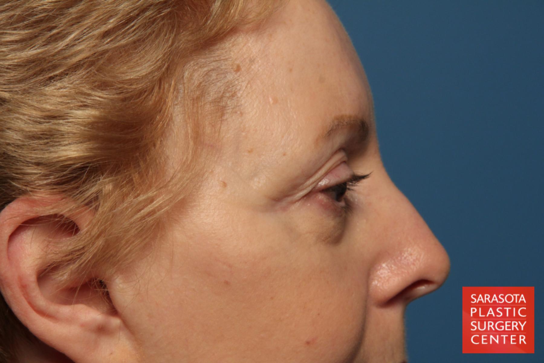 Eyelid Lift: Patient 41 - Before and After 6