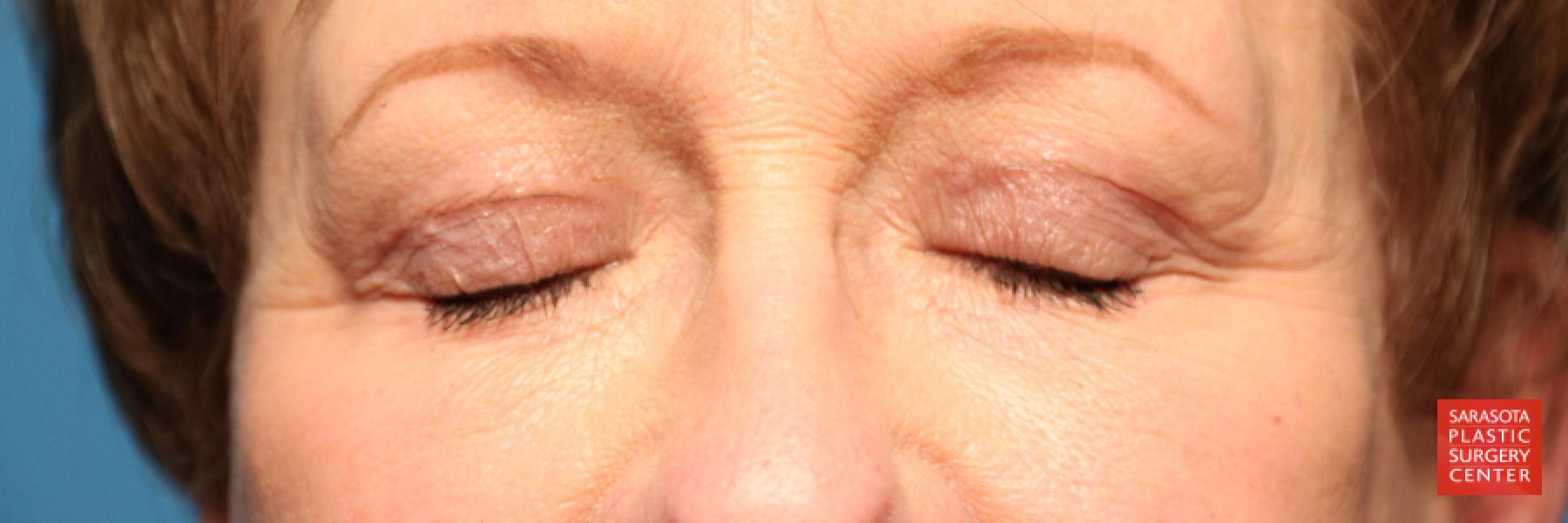 Eyelid Lift: Patient 20 - After 3