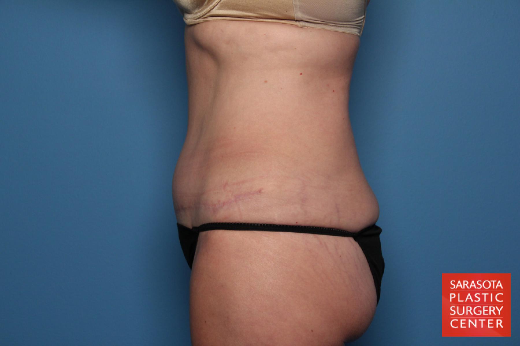 Tummy Tuck: Patient 18 - After 3
