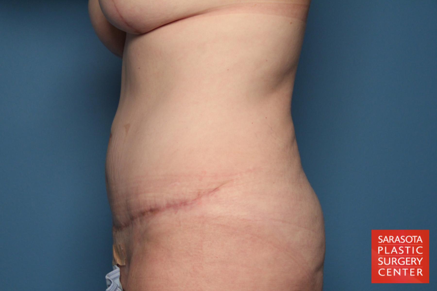Tummy Tuck: Patient 17 - After 3