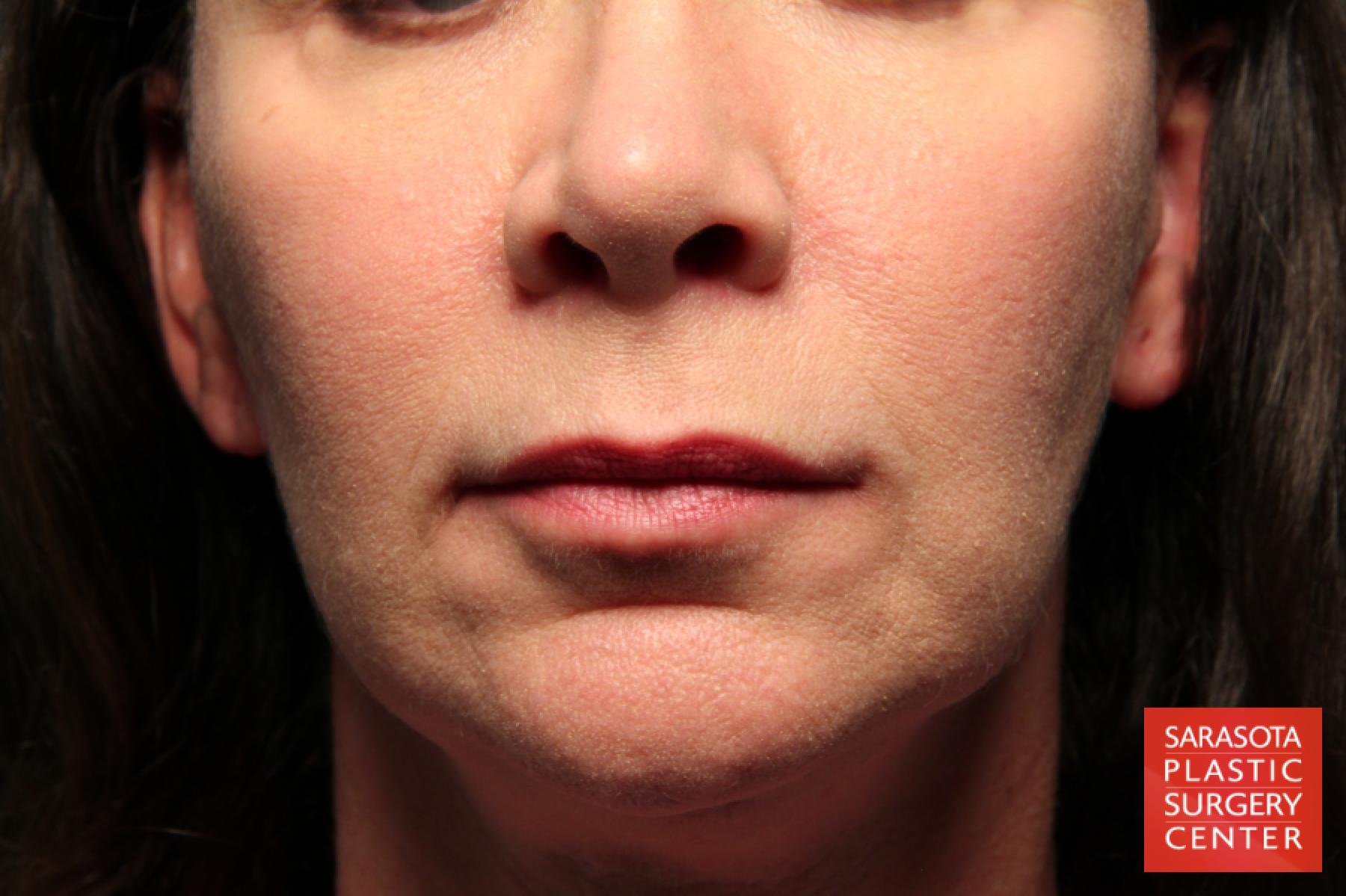 Fat-transfer---face-revision: Patient 1 - After  