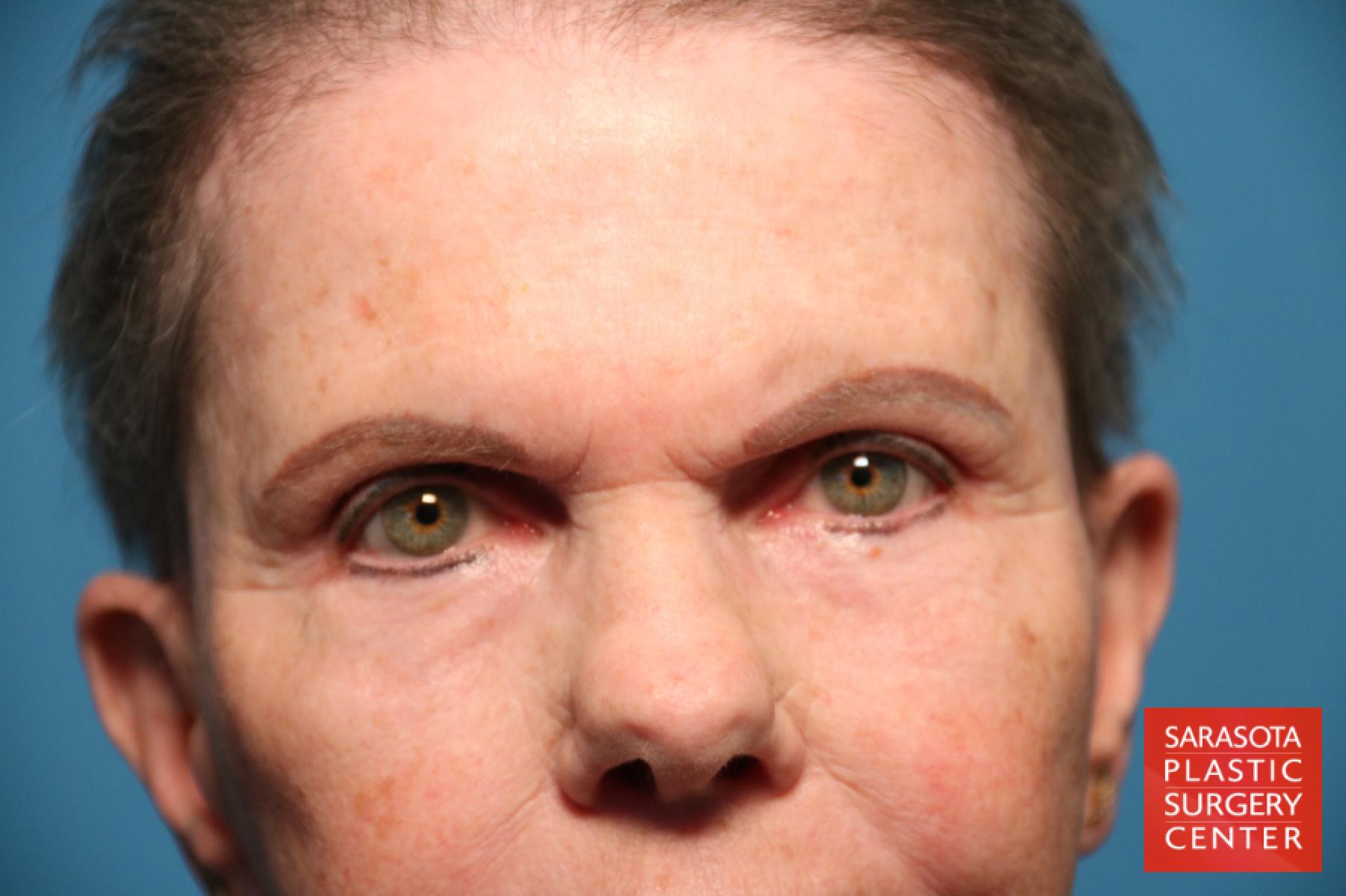 Eyelid Lift: Patient 29 - After 1