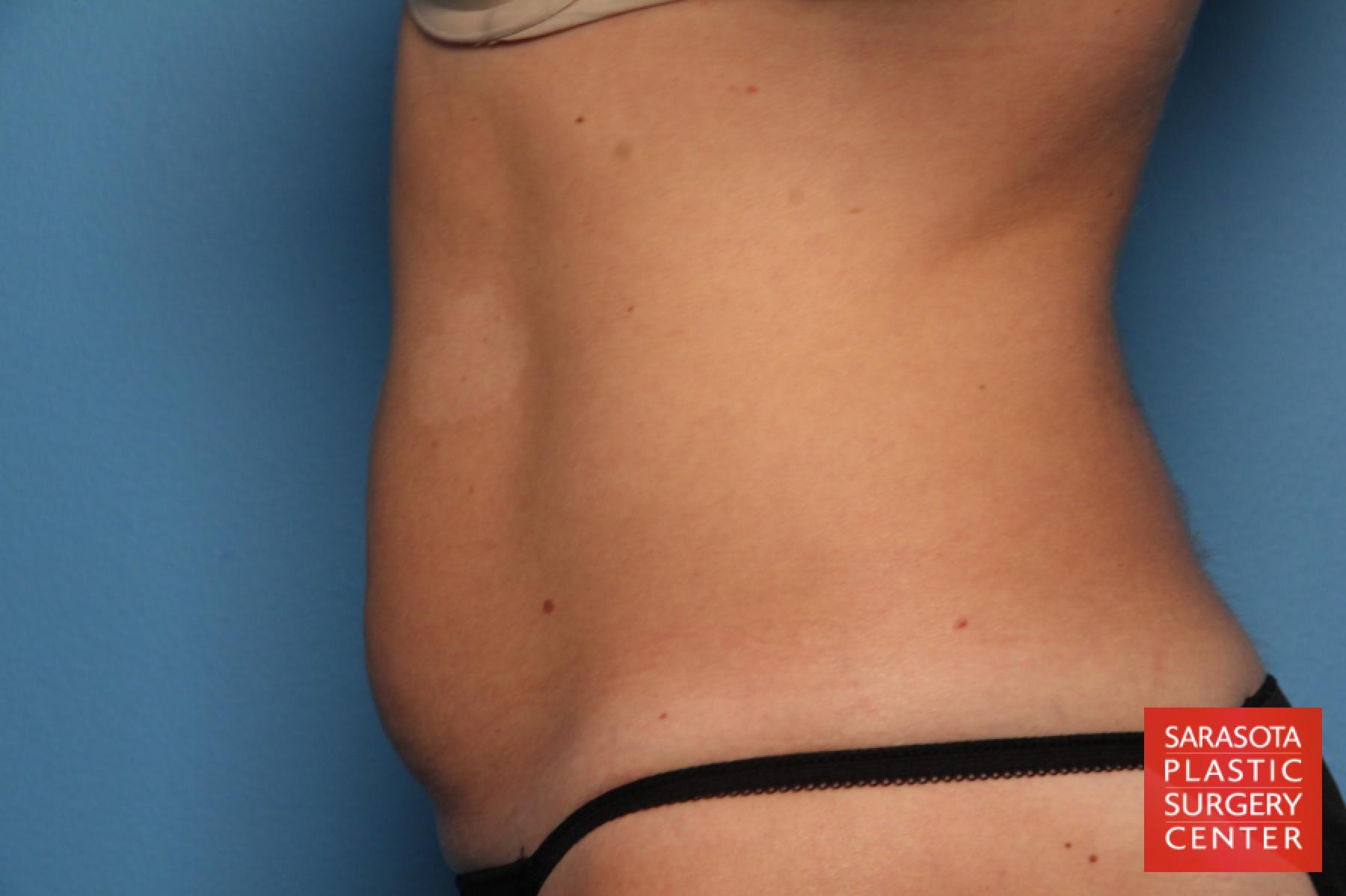 Tummy Tuck: Patient 8 - Before and After 3