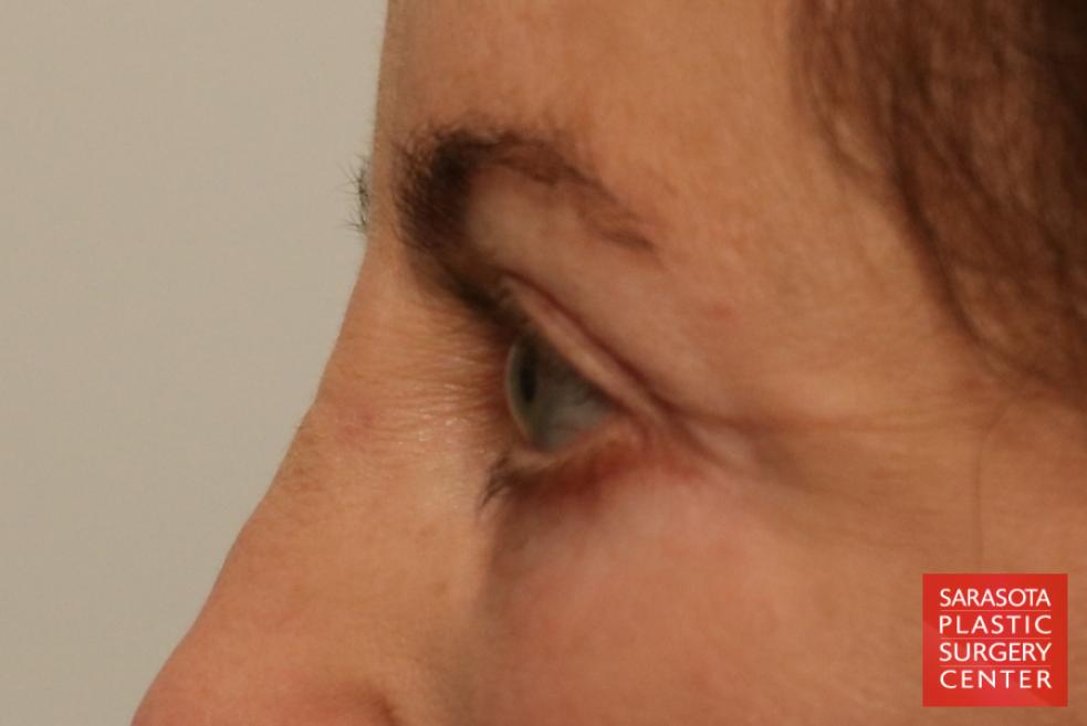 Eyelid Lift: Patient 39 - After 4