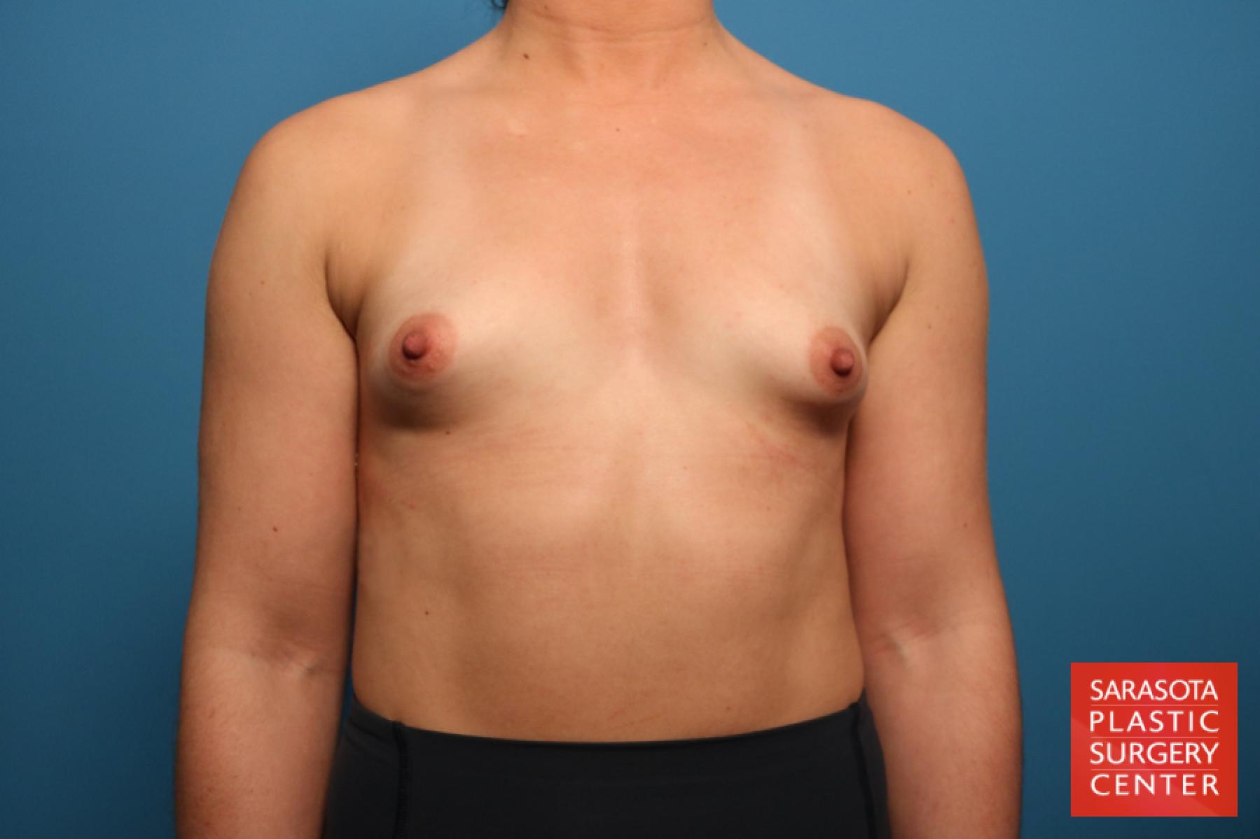 Breast Augmentation: Patient 64 - Before 1