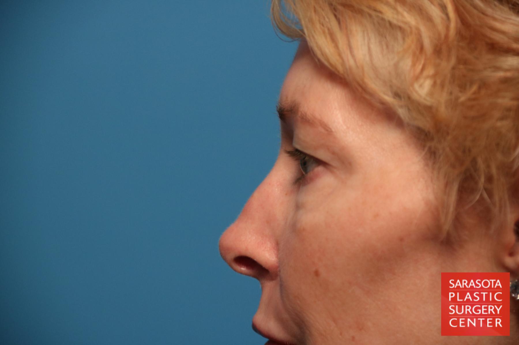 Eyelid Lift: Patient 12 - Before 4