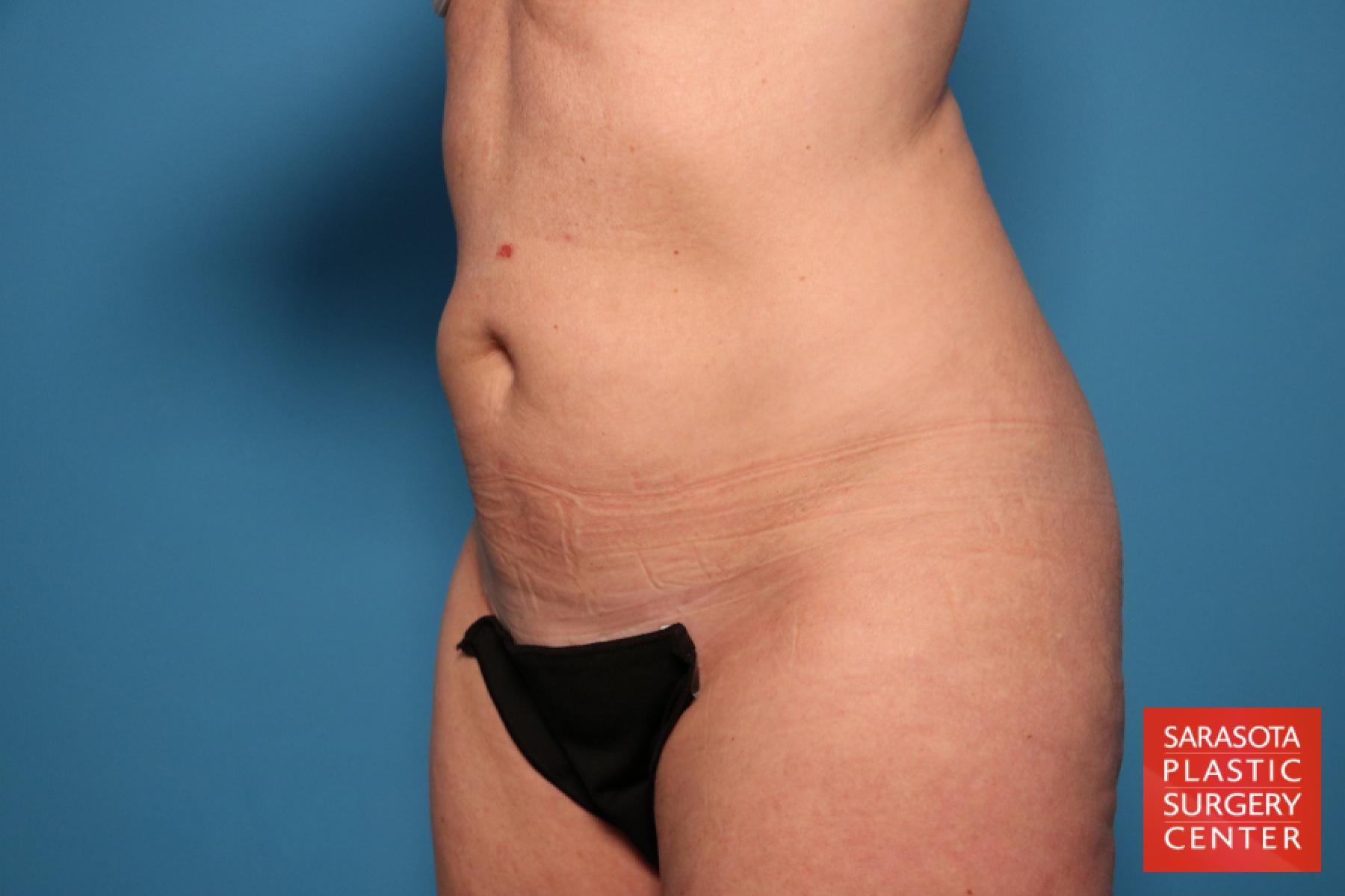Tummy Tuck: Patient 1 - Before 2